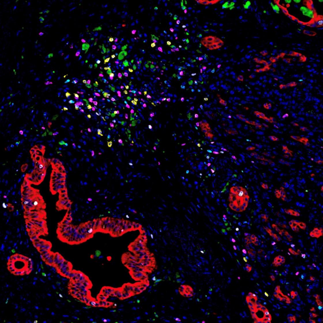 免疫细胞聚集在胰腺癌细胞周围的荧光图像