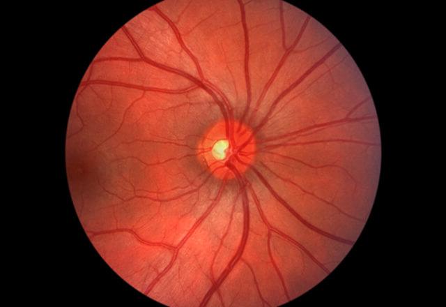 microscopic image of the eye's cornea